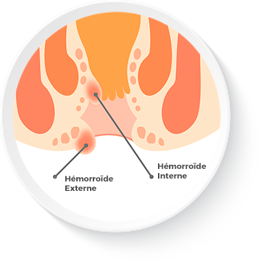 Hémorroïdes : facteurs favorisants et symptômes